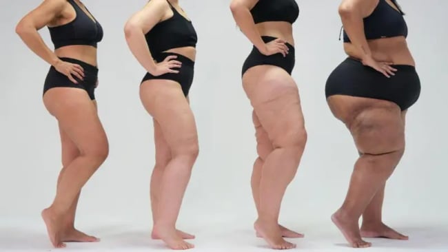 Lipedema - Lumevié
