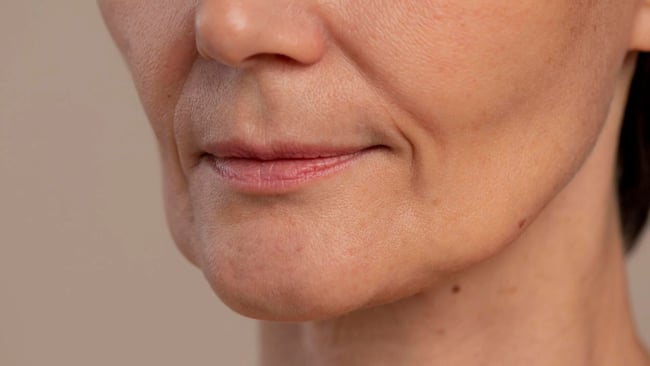 Flacidez Facial - Lumevié